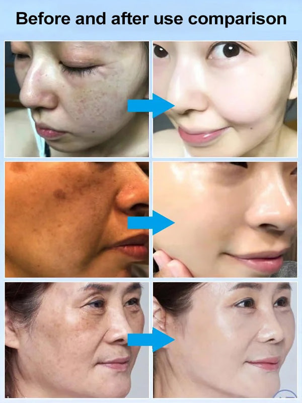 🔥- 【Gamla fläckar och gula fläckar försvinner】 Spot Fading Urea Cream