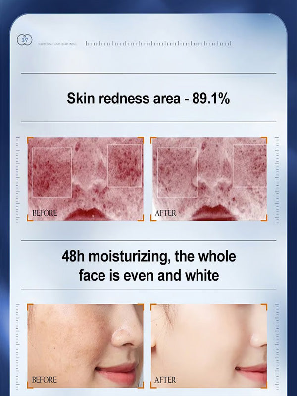 🔥- 【Gamla fläckar och gula fläckar försvinner】 Spot Fading Urea Cream