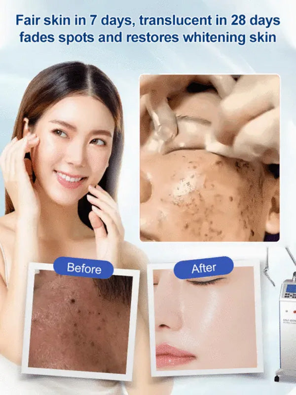 🔥- 【Gamla fläckar och gula fläckar försvinner】 Spot Fading Urea Cream